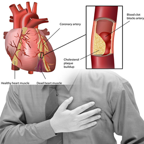 Ateroskleroza kao bolest životnog stila - bolest krvnih sudova. Bolesti srca, prvenstveno infarkt i hipertenzija trenutno ubijaju najviše ljudi.