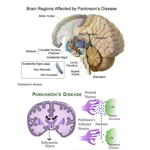 Neurološke bolesti - Neurološke smetnje. Multipla skleroza, parkinsonova bolest, alchajmer, demencija, migrena, tumor mozga, epilepsija, autizam...
